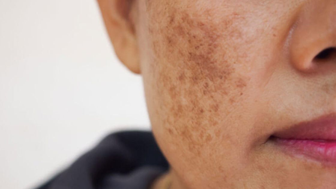 Hyperpigmentation_Melasma