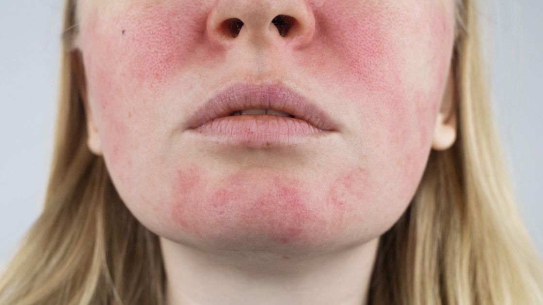 Rosacea