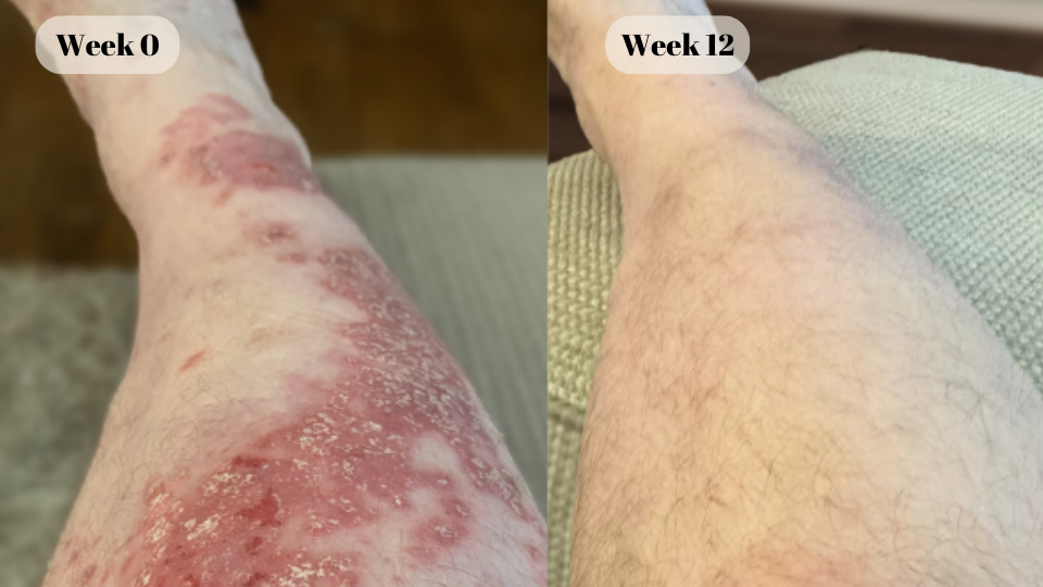 psoriasis before and after (2)