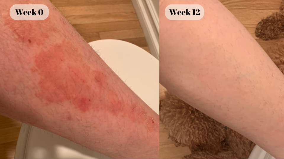 psoriasis before and after (3)