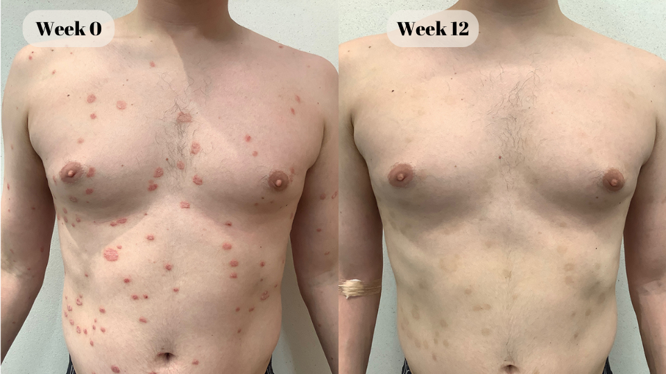 psoriasis before and after (5)