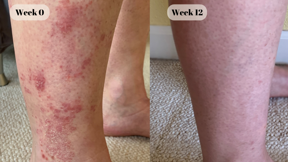 psoriasis before and after