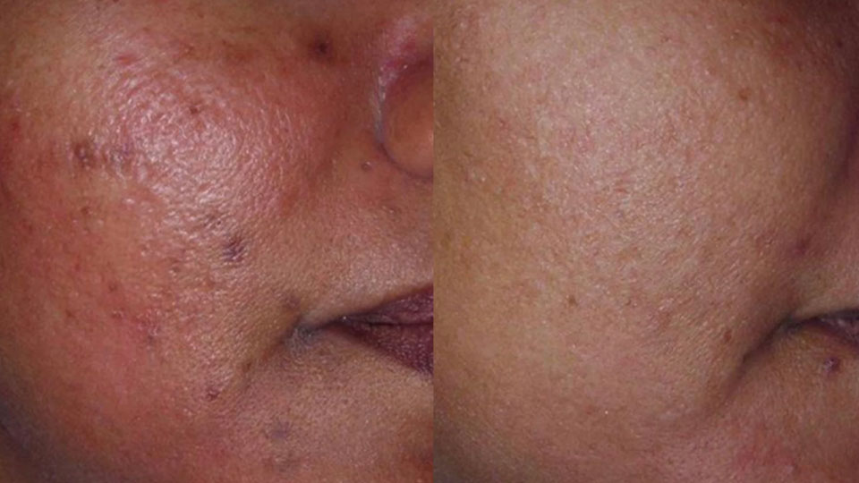 Melasma-Before-After-3