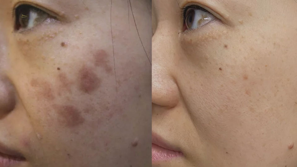 Melasma-Before-After-4