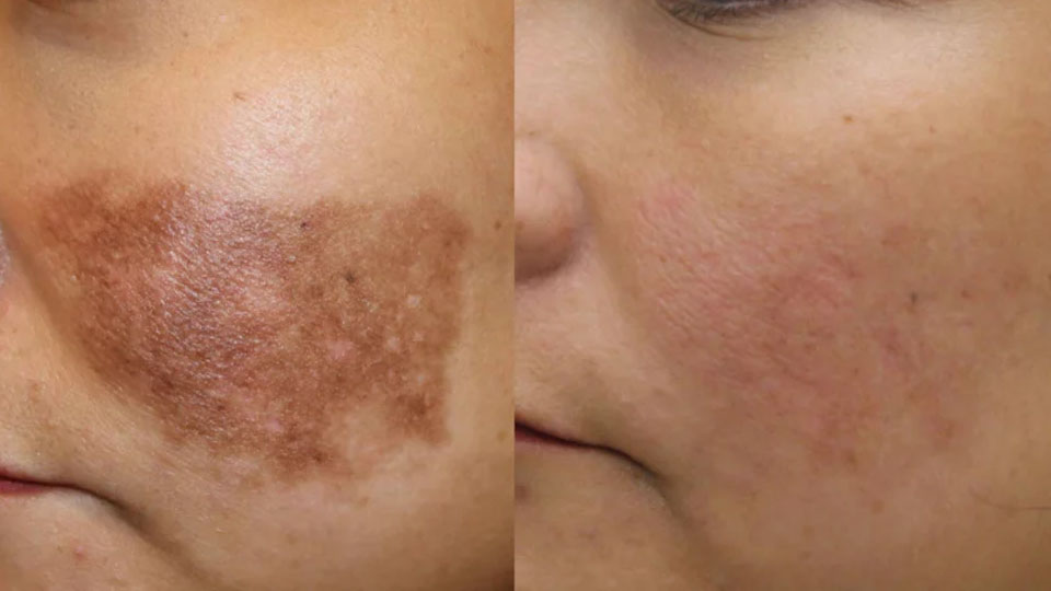 Melasma-Before-After-5