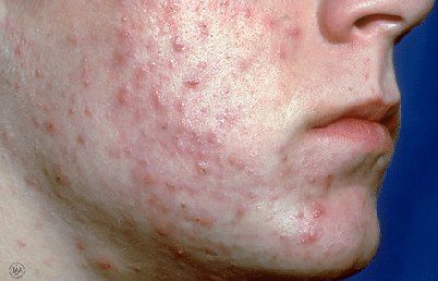 Severe Acne Care