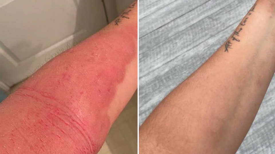 eczema-before-after-2