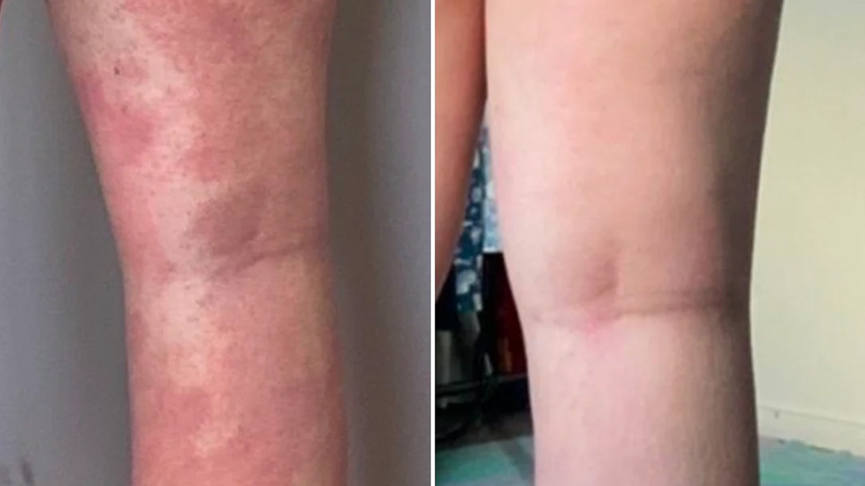 eczema-before-after-3