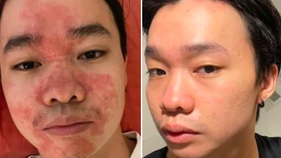 eczema-before-after-4