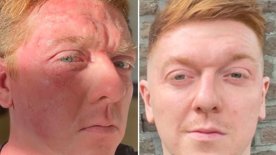 eczema-before-after-5
