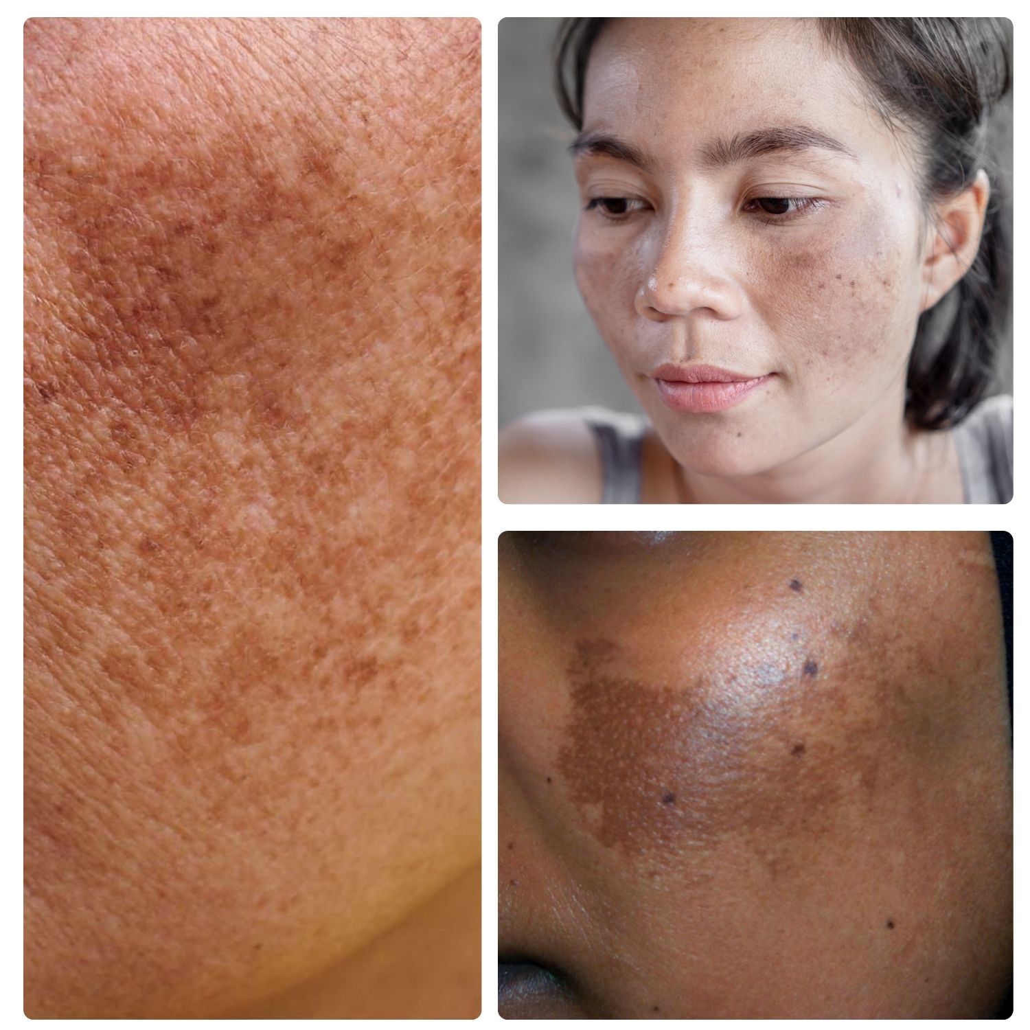 melasma treatments