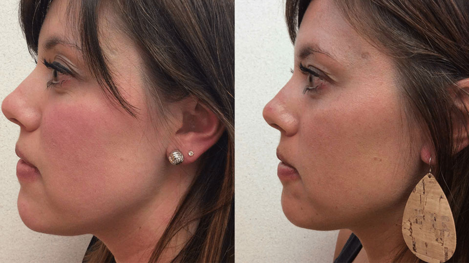 rosacea-after-before-2