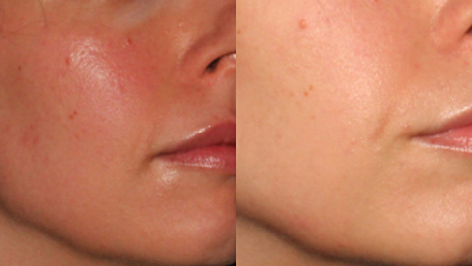 rosacea-after-before-4