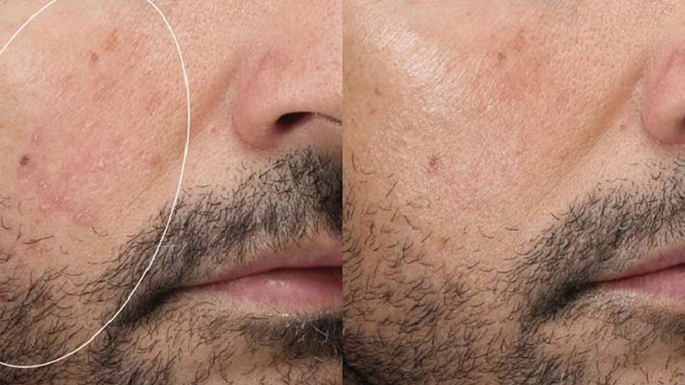 rosacea-after-before-5