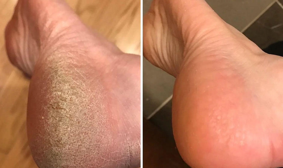 athelte-before-after4