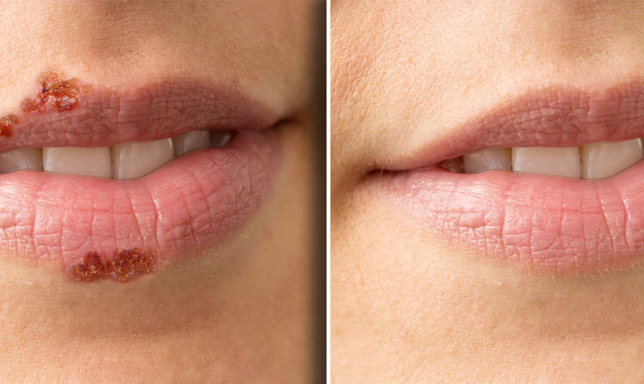cold-sore-before-after