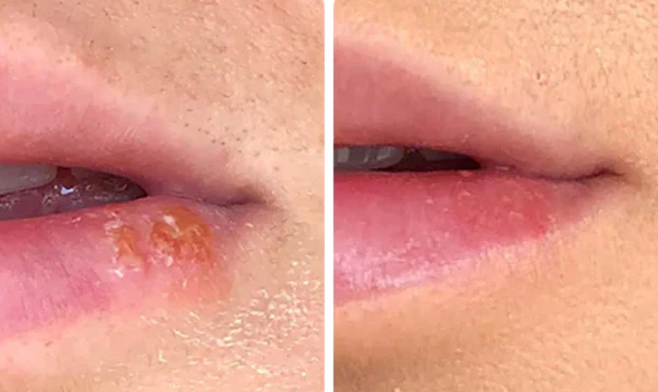 cold-sore-before-after2