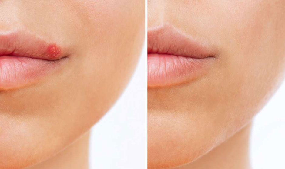 cold-sore-before-after3