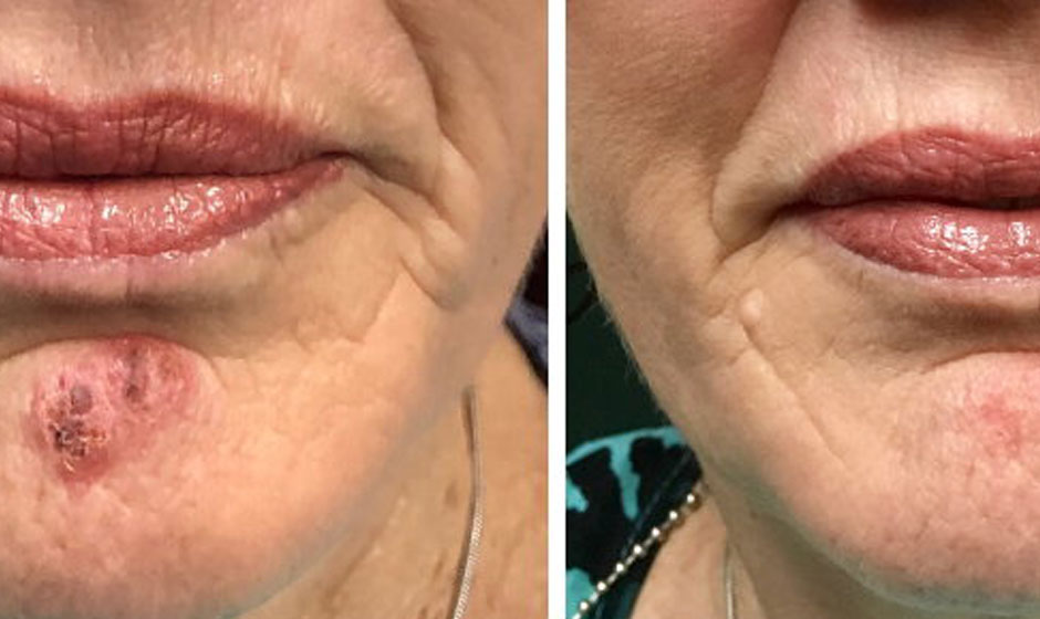 cold-sore-before-after5