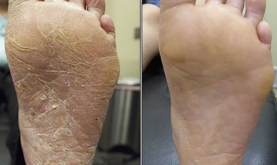 footr-before-after-1