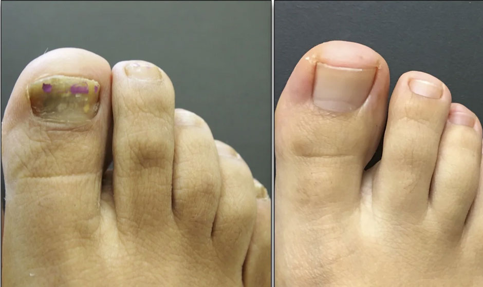 nail-before-after