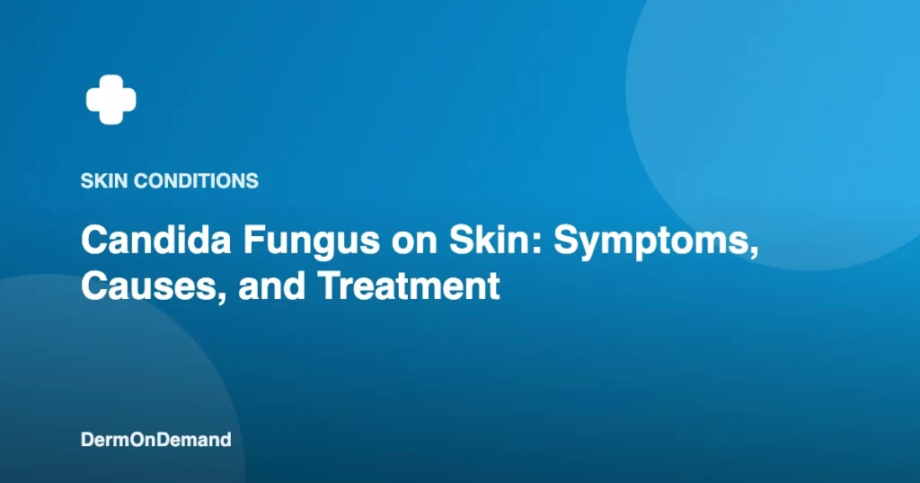 Candida Fungus on Skin Symptoms, Causes, and Treatment - DermOnDemand dermatology guide illustration covering skin conditions, treatments