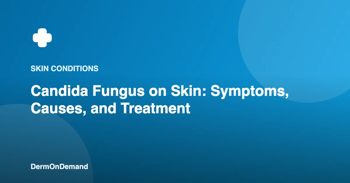 Candida Fungus on Skin Symptoms, Causes, and Treatment - DermOnDemand dermatology guide illustration covering skin conditions, treatments