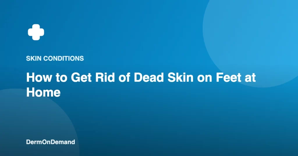 How to Get Rid of Dead Skin on Feet at Home - DermOnDemand dermatology guide illustration covering skin conditions, treatments
