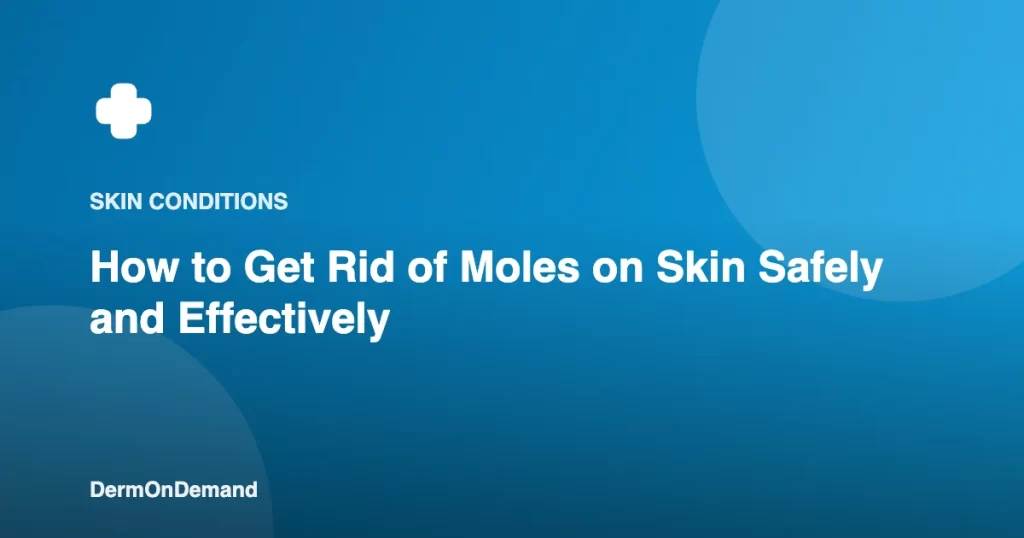 How to Get Rid of Moles on Skin Safely and Effectively - DermOnDemand dermatology guide illustration covering skin conditions, treatments