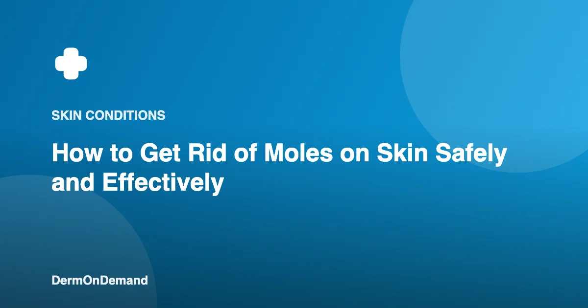 How to Get Rid of Moles on Skin Safely and Effectively - DermOnDemand dermatology guide illustration covering skin conditions, treatments