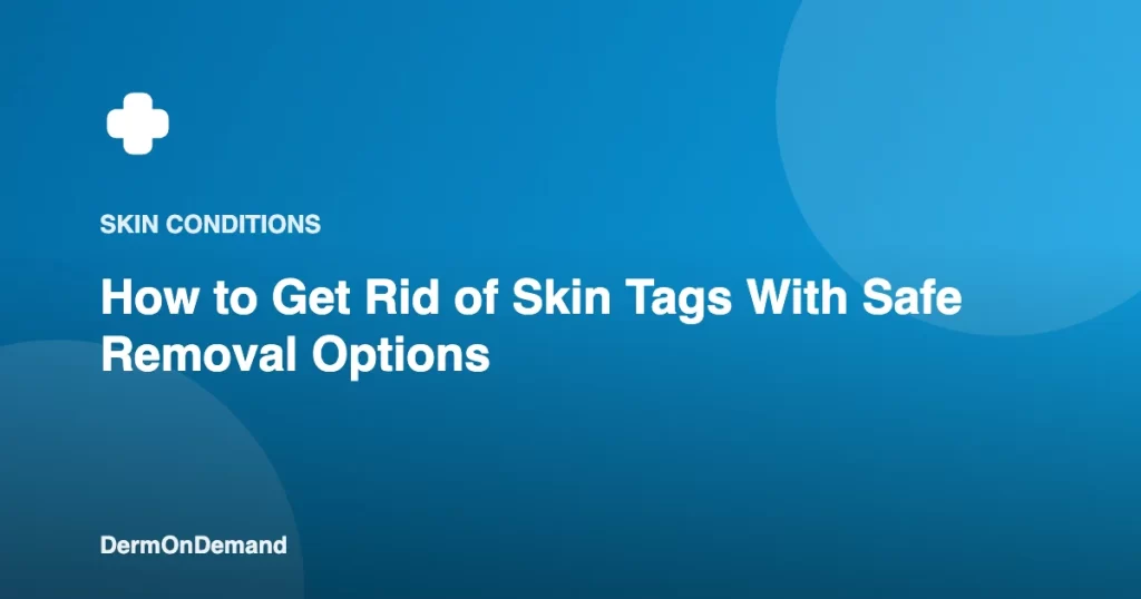 How to Get Rid of Skin Tags With Safe Removal Options - DermOnDemand dermatology guide illustration covering blog, skin conditions
