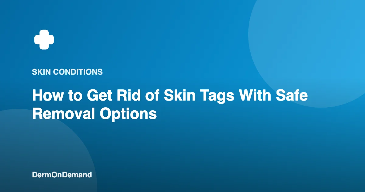 How to Get Rid of Skin Tags With Safe Removal Options - DermOnDemand dermatology guide illustration covering blog, skin conditions