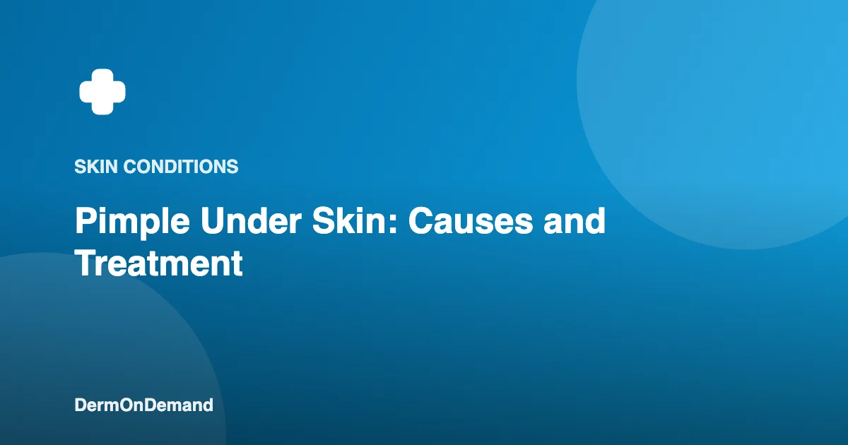 Pimple Under Skin Causes and Treatment - DermOnDemand dermatology guide illustration covering skin conditions
