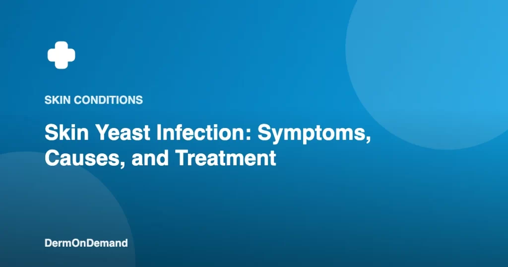 Skin Yeast Infection Symptoms, Causes, and Treatment - DermOnDemand dermatology guide illustration covering skin conditions